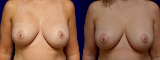 Frontal View - Breast Implant Revision