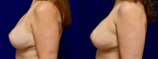 Left Profile View - Breast Implant Revision