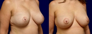 Right 3/4 View - Breast Implant Revision