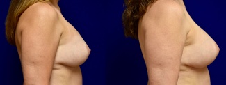 Right Profile View - Breast Implant Revision