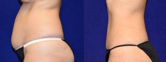 Left Profile View - Tummy Tuck