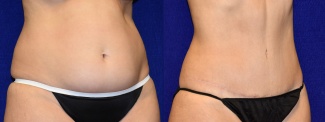 Right 3/4 View - Tummy Tuck