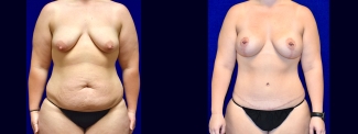 Frontal View - Mommy Makeover - Breast Augmentation, Breast Lift, Tummy Tuck