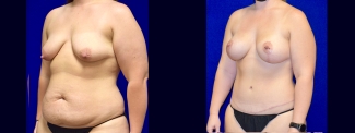 Left 3/4 View - Mommy Makeover - Breast Augmentation, Breast Lift, Tummy Tuck