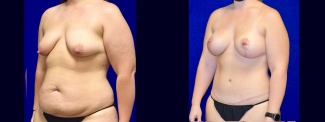 Left 3/4 View - Mommy Makeover - Breast Augmentation, Breast Lift, Tummy Tuck