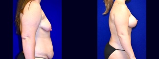 Right Profile View - Mommy Makeover - Breast Augmentation, Breast Lift, Tummy Tuck