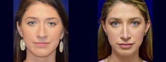 Frontal View - Rhinoplasty