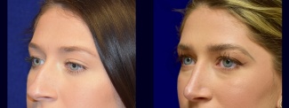 Left 3/4 View - Rhinoplasty