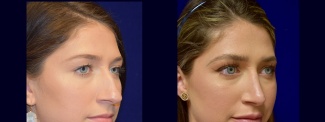 Right 3/4 View - Rhinoplasty