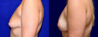 Left Profile View - Surgery After Weight Loss Breat Lift