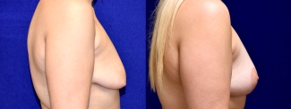 Right Profile View - Surgery After Weight Loss Breat Lift