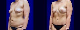 Left 3/4 View - Surgery After Weighloss with Breat lift, Tummy Tuck