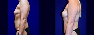Left Profile View - Surgery After Weighloss with Breat lift, Tummy Tuck