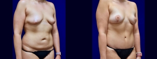 Right 3/4 View - Surgery After Weighloss with Breat lift, Tummy Tuck