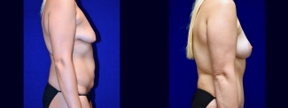 Right Profile View - Surgery After Weighloss with Breat lift, Tummy Tuck