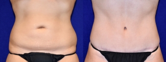 Frontal View - Surgery After Weight Loss Tummy Tuck