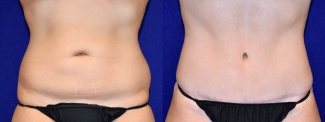 Frontal View - Surgery After Weight Loss Tummy Tuck