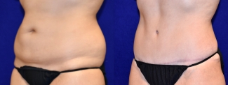 Left 3/4 View - Surgery After Weight Loss Tummy Tuck