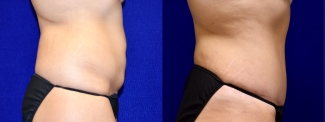 Right Profile View - Surgery After Weight Loss Tummy Tuck
