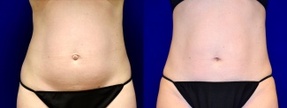 Frontal View - Mini Tummy Tuck