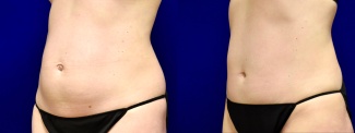 Left 3/4 View - Mini Tummy Tuck