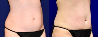 Right 3/4 View - Mini Tummy Tuck