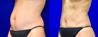 Left 3/4 View - Tummy Tuck