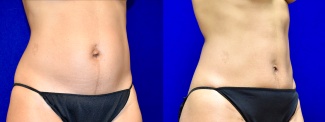 Right 3/4 View - Tummy Tuck