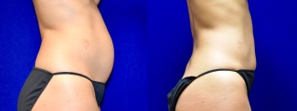 Right Profile View - Tummy Tuck