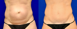 Frontal View - Tummy Tuck