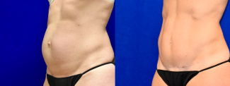 Left 3/4 View - Tummy Tuck