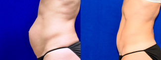 Left Profile View - Tummy Tuck