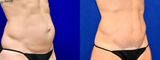 Right 3/4 View - Tummy Tuck