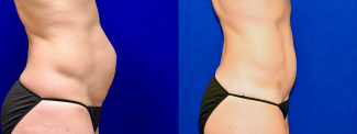 Right Profile View - Tummy Tuck