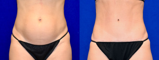Frontal View - Tummy Tuck with Flank Liposuction