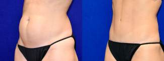 Left 3/4 View - Tummy Tuck with Flank Liposuction