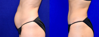 Left Profile View - Tummy Tuck with Flank Liposuction