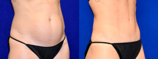 Right 3/4 View - Tummy Tuck with Flank Liposuction