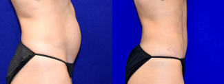 Right Profile View - Tummy Tuck with Flank Liposuction