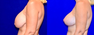Left Profile View - Breast Implant Revision with Breast Lift