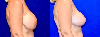Right Profile View - Breast Implant Revision with Breast Lift