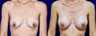 Frontal View - Breast Augmentation with Nipple Reduction