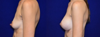 Left Profile View - Breast Augmentation with Nipple Reduction