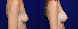 Right Profile View - Breast Augmentation with Nipple Reduction