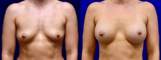 Frontal View - Breast Augmentation