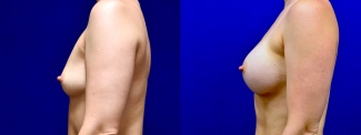 Left Profile View - Breast Augmentation