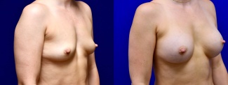 Right 3/4 View - Breast Augmentation
