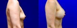 Right Profile View - Breast Augmentation