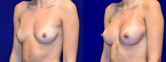 Left 3/4 View - Breast Augmentation