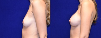 Left Profile View - Breast Augmentation